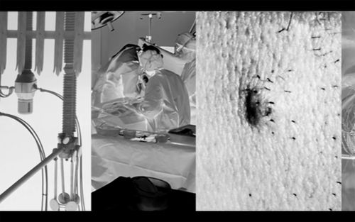 Video composite showing images in negative, including a view of surgeons at work